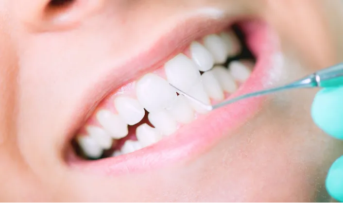 Composite Bonding