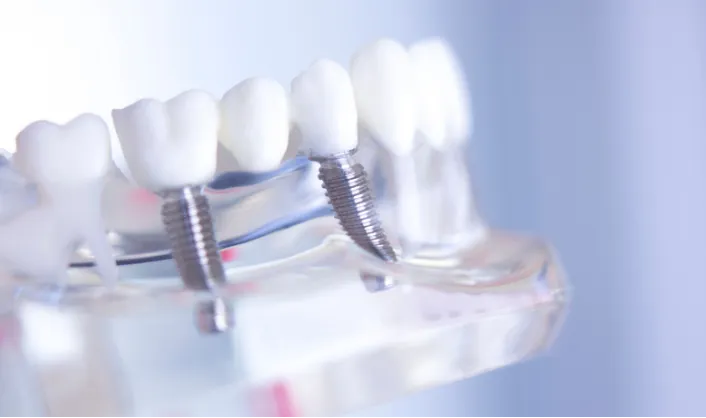 Dental Implants