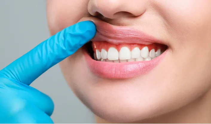 Gummy Smile Correction
