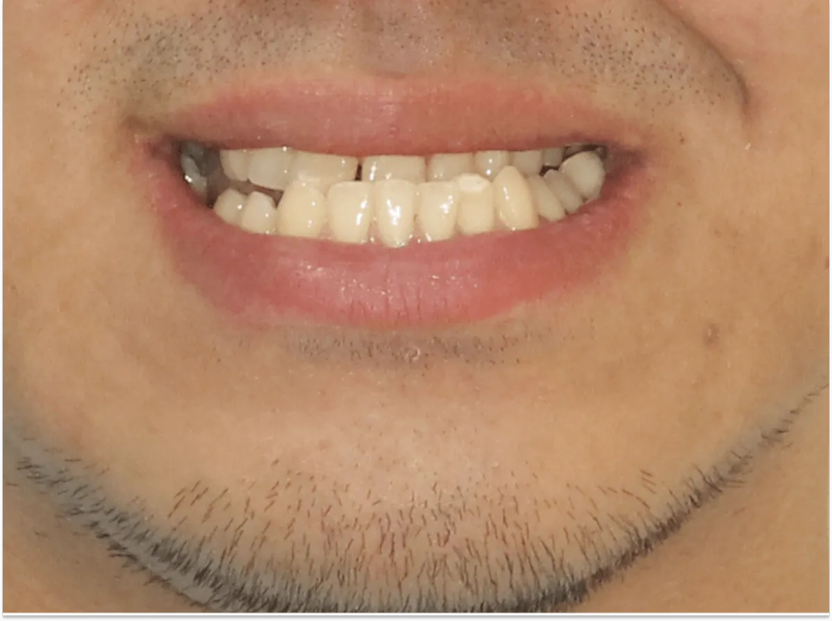 Smile makeover 3