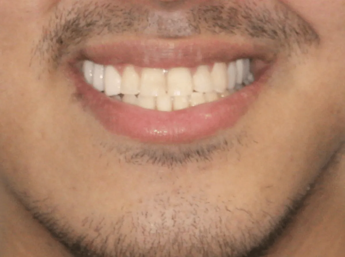 Smile makeover 4