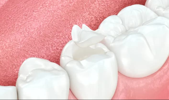 Tooth-Colored Fillings
