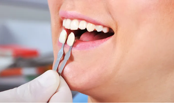 Veneers