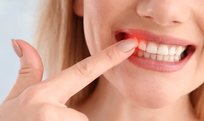 Root Canal Treatment