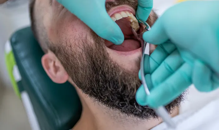 Tooth Extractions