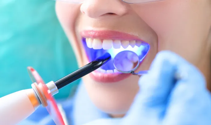 Tooth Fillings