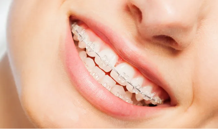 Ceramic Braces