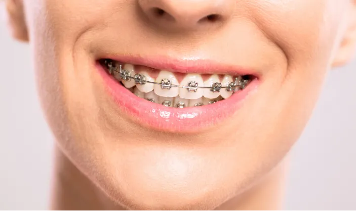 Self-Ligating Braces