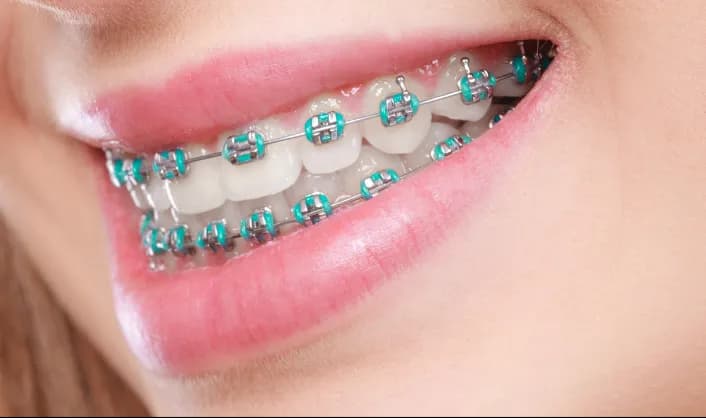 Traditional Metal Braces