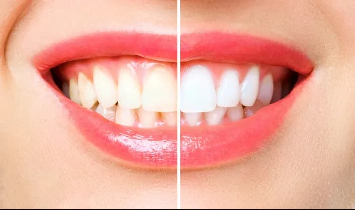 Teeth Whitening