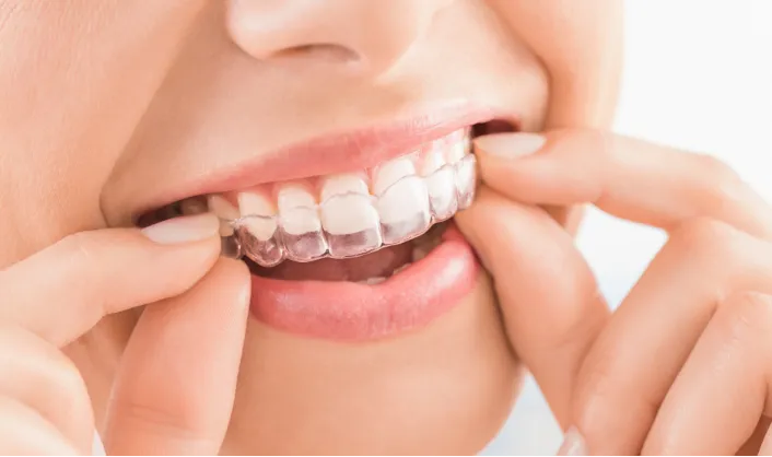 Clear Aligners