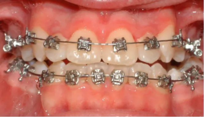 Orthodontic case 2
