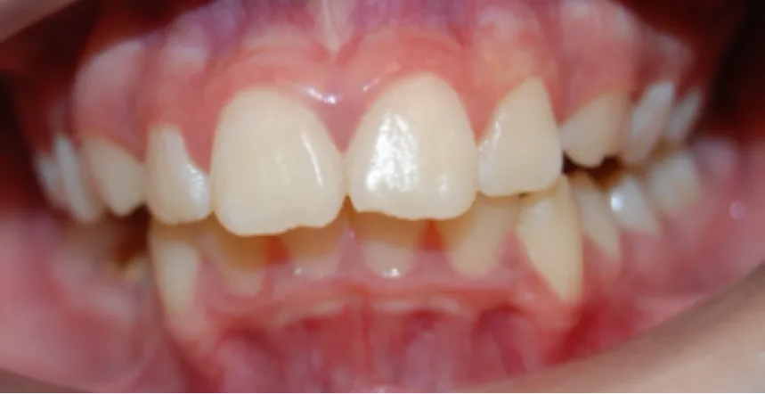 Orthodontic case 3