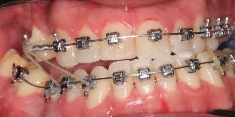 Orthodontic case 5